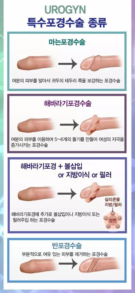 남성 ㅈㅈ 수술 종류