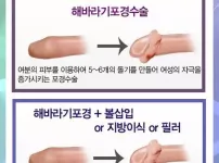 남성 ㅈㅈ 수술 종류
